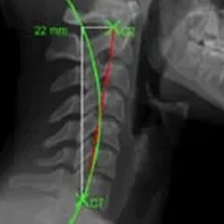 X-ray image of the cervical spine with green and red lines marking curvature and measurements.