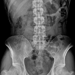 X-ray of the lower spine and pelvis showing vertebrae and hip bones in detail.