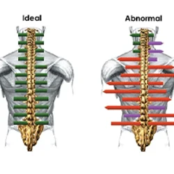 Comparison of two spines labeled “Ideal” and “Abnormal,” with colored arrows indicating alignment differences.