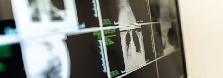 Computer screen displaying multiple X-ray images of the chest.