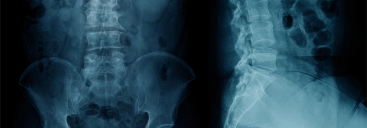 X-ray of the lower spine and pelvis from front and side views.